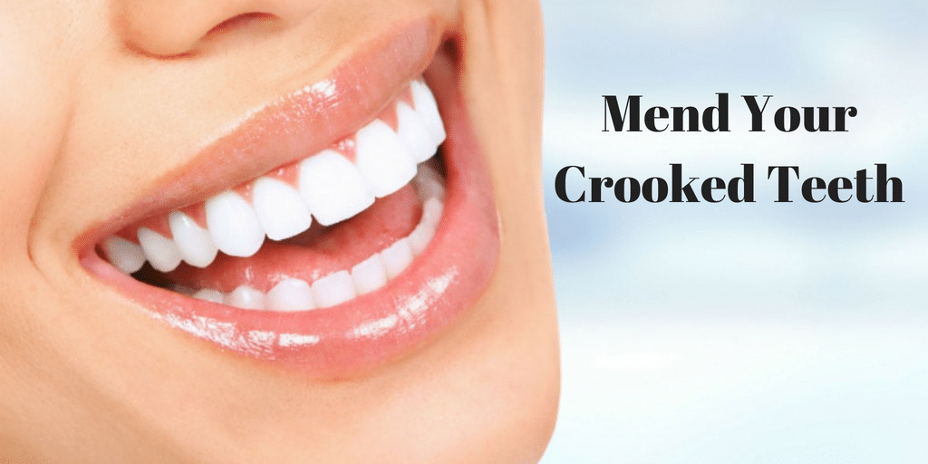 Treatment to Mend Your Crooked Teeth
