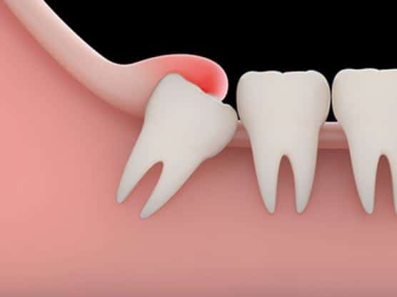 Wisdom-Tooth