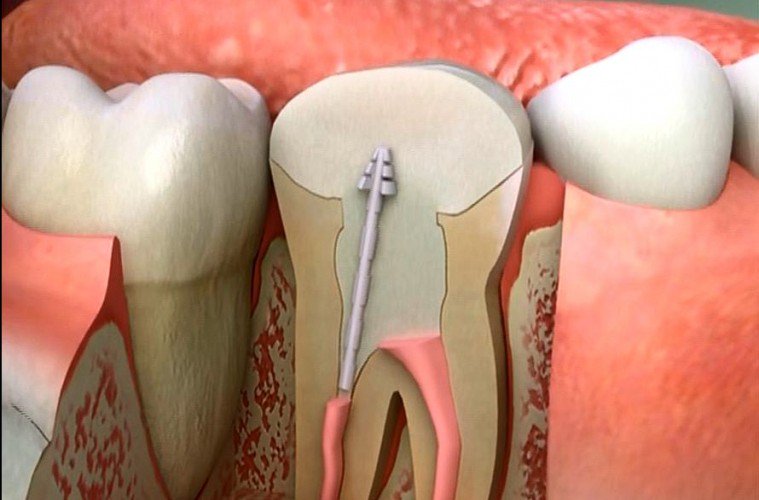 Precautions After Root Canal Treatment