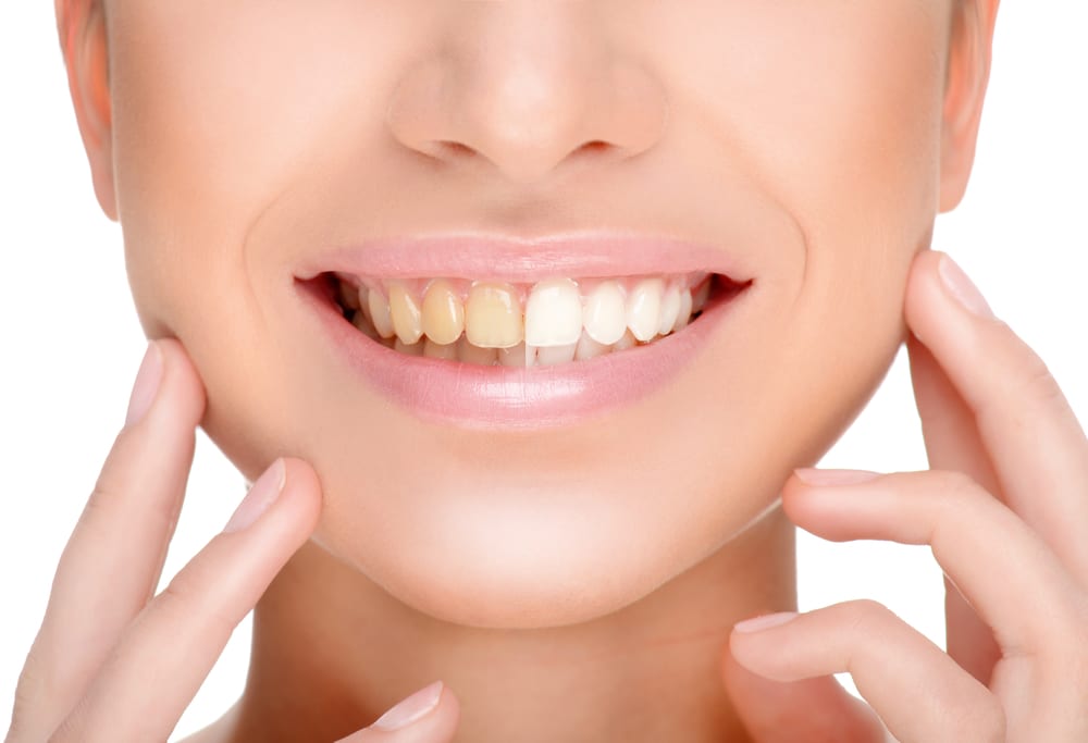 Teeth whitening benefits