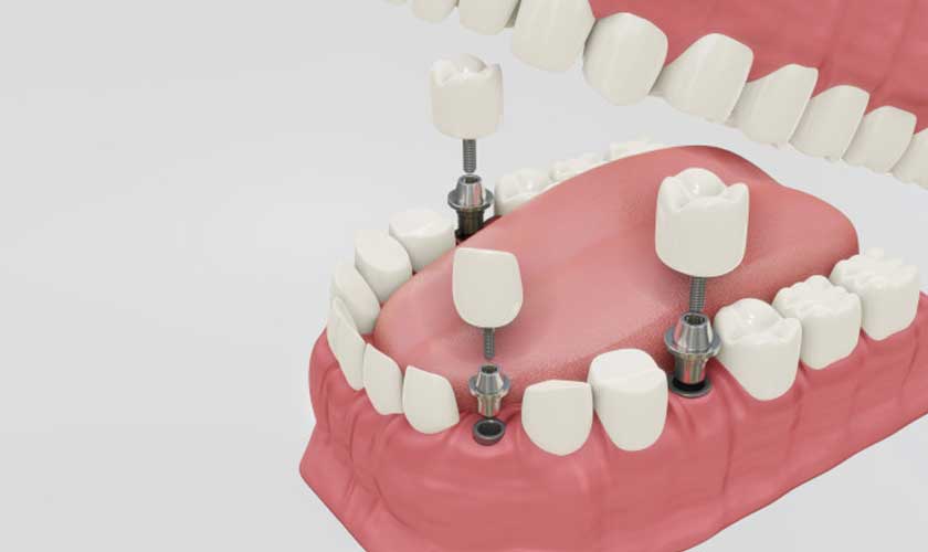 Dental Implants - Advanced Family Dentistry