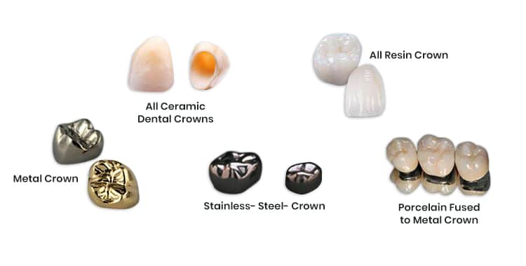 types-of-dental-crowns