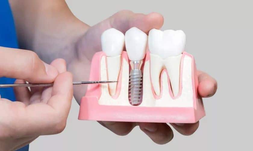 How-Much-Bone-Is-Required-For-Dental-Implants