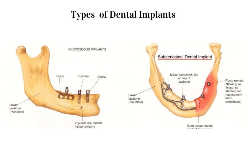Types of dental implants | Advanced Family Dentistry Nashua