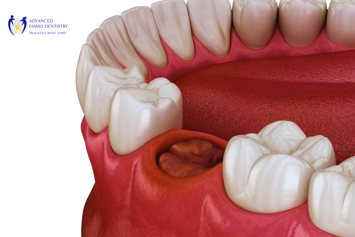 Swallowing to Avoid Dry Socket