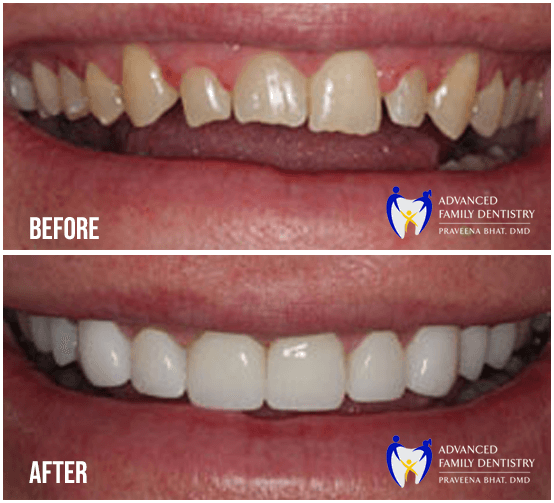 Before and After image of Cosmetic Dentist Treatment in Nashua