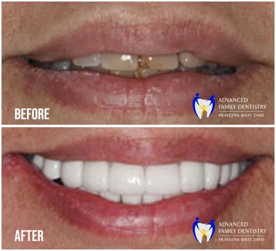 Before and After Image of Teeth Whitening treatment in Nashua
