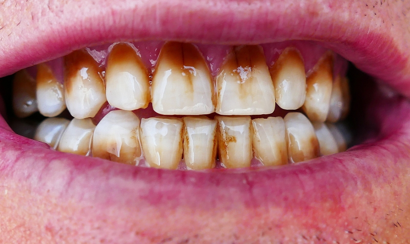 How To Remove Coffee Stains From Teeth Naturally