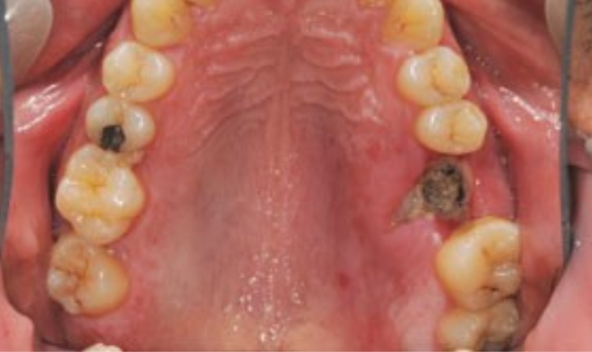 How o swallow to avoid dry socket ? Advanced Family Dentistry Nashua