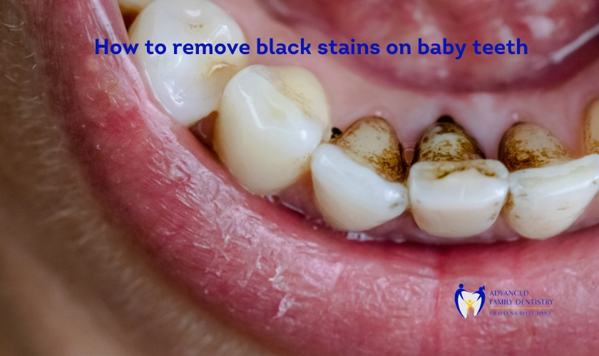 Close-up of a smiling baby's mouth showing black stains on the teeth, representing the need to remove them effectively in Nashua.