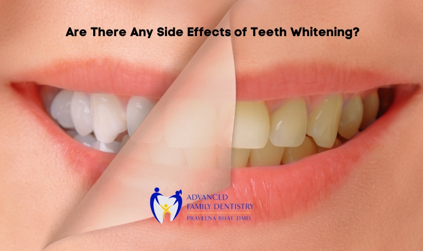 Side effects of Teeth Whitening in Nashua