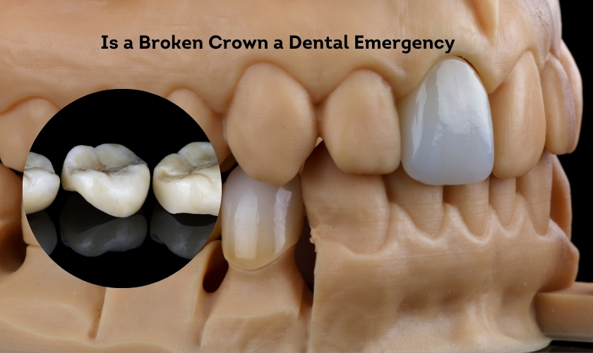 Is a Broken Crown a Dental Emergency - Advanced Family Dentistry Nashua