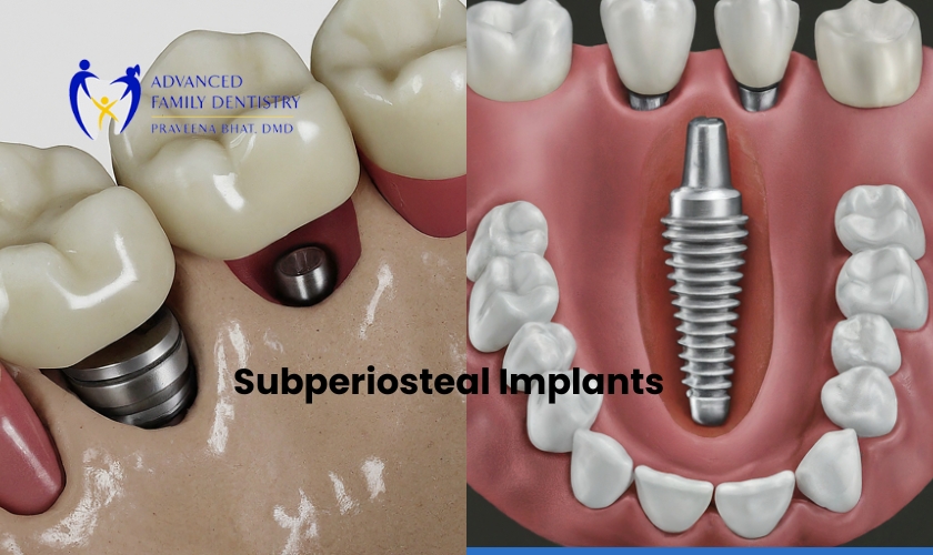 When Would a Subperiosteal Implant be Recommended to a Patient?