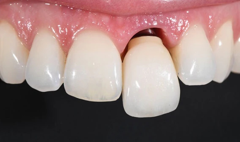 Can a Loose Tooth Tighten Back Up?