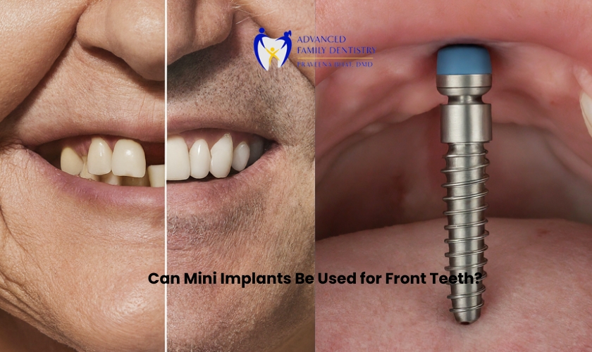 Can Mini Implants Be Used for Front Teeth?