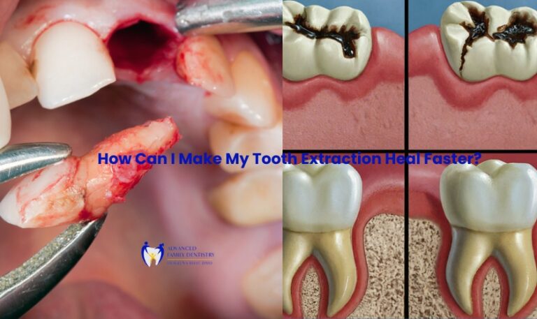 Signs Of Sepsis From Tooth Infection