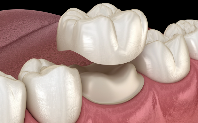 When Is a Dental Crown Necessary