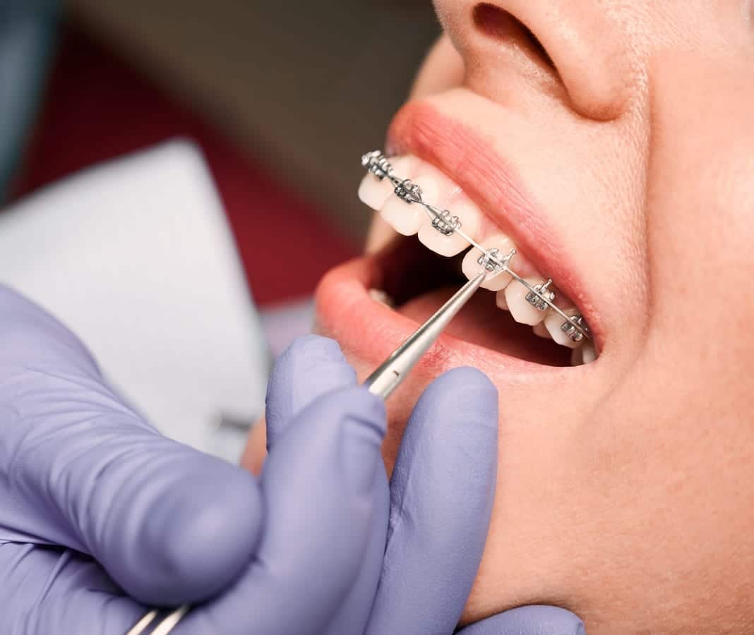 What Happens to Your Mouth When You Skip Full-Mouth Restoration