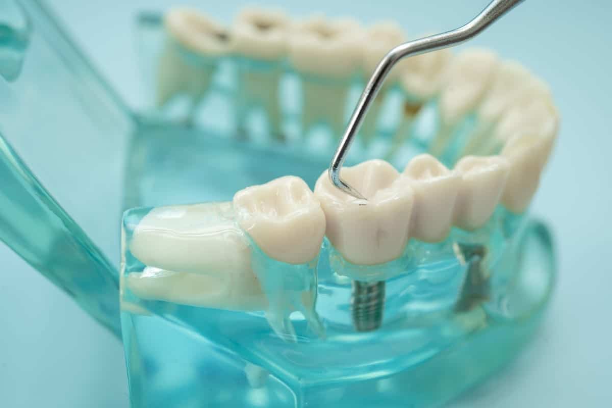 Dental Bridges in Nashua